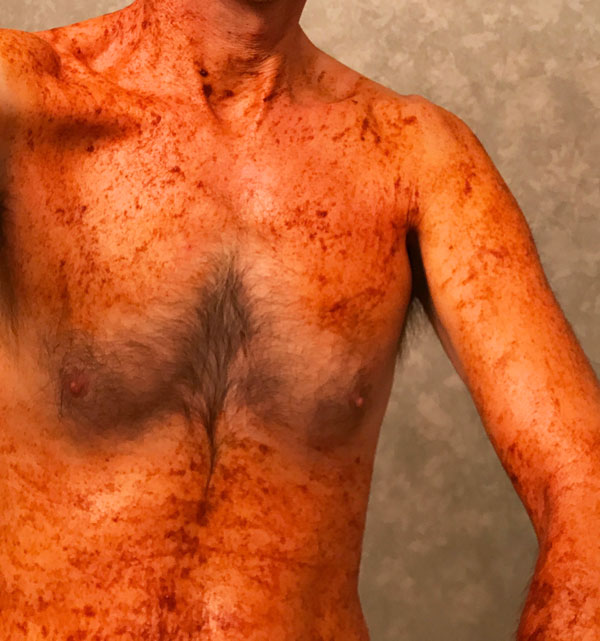 Cayenne pepper for scabies - The Scabies Cure